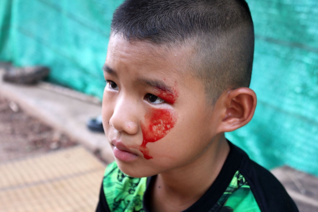 เลื่อนรักษา "น้องเติ้ล" เหงื่อเป็นเลือด เหตุ! เตียงไม่ว่าง