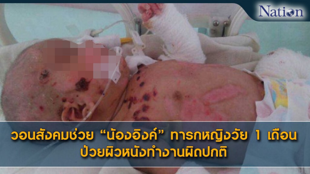 วอนช่วยลูกน้อย ป่วยผิวหนังทำงานผิดปกติ