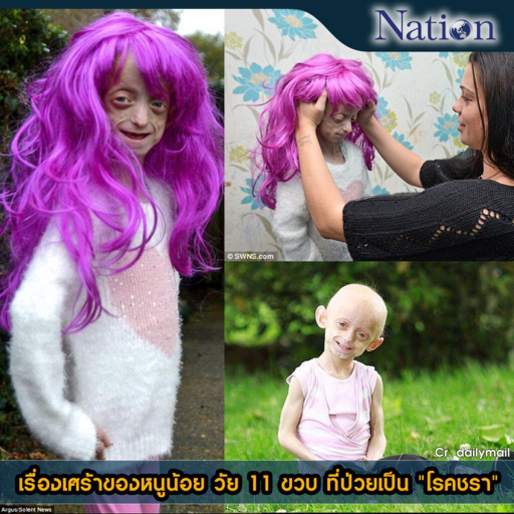เรื่องเศร้าของหนูน้อย วัย 11 ขวบ ที่ป่วยเป็น "โรคชรา" เรื่องเศร้าของหนูน้อย วัย 11 ขวบ ที่ป่วยเป็น "โรคชรา"