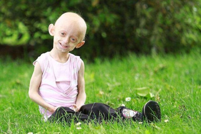 เรื่องเศร้าของหนูน้อย วัย 11 ขวบ ที่ป่วยเป็น "โรคชรา"