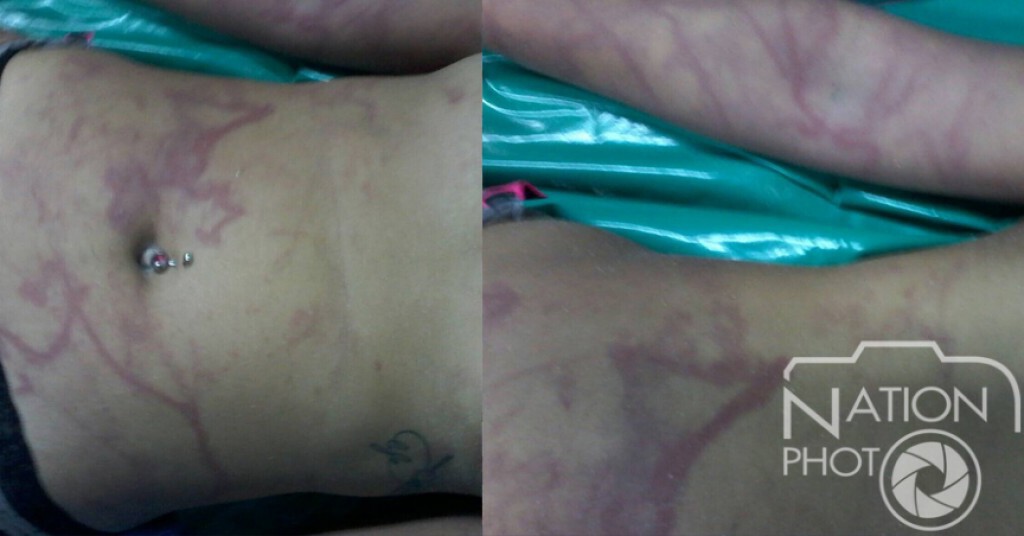 นักท่องเที่ยวสาวถูกพิษแมงกะพรุนกล่อง"เสียชีวิต" ที่เกาะพะงัน