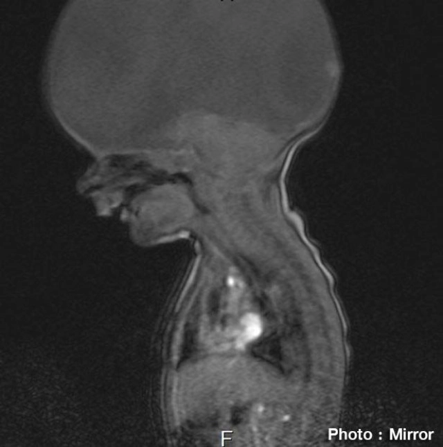 ปาฎิหาริย์! เมื่อทารกไม่มีสมอง เรียก"แม่"ได้ ครั้งแรก