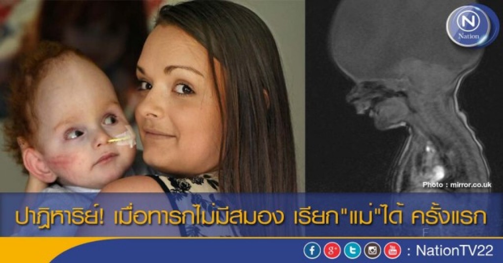 ปาฎิหาริย์! เมื่อทารกไม่มีสมอง เรียก"แม่"ได้ ครั้งแรก