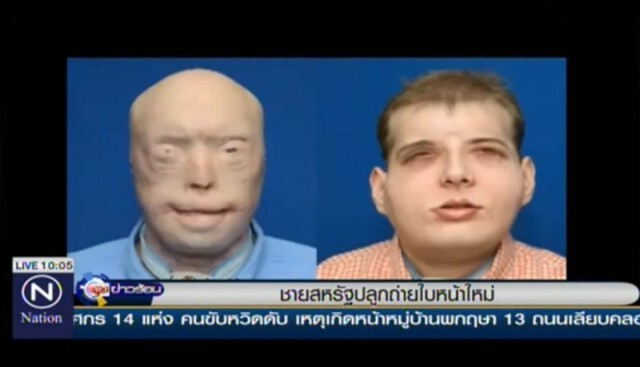 หนุ่มอเมริกันปลูกถ่ายใบหน้าใหม่  หลังถูกไฟไหม้เสียโฉมขณะช่วยผู้หญิง