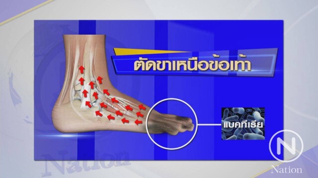 ติดเชื้อรุนแรง...ทำไมต้องตัดขา?