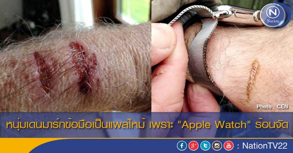 หนุ่มเดนมาร์กข้อมือเป็นแผลไหม้ เพราะ "Apple Watch" ร้อนจัด