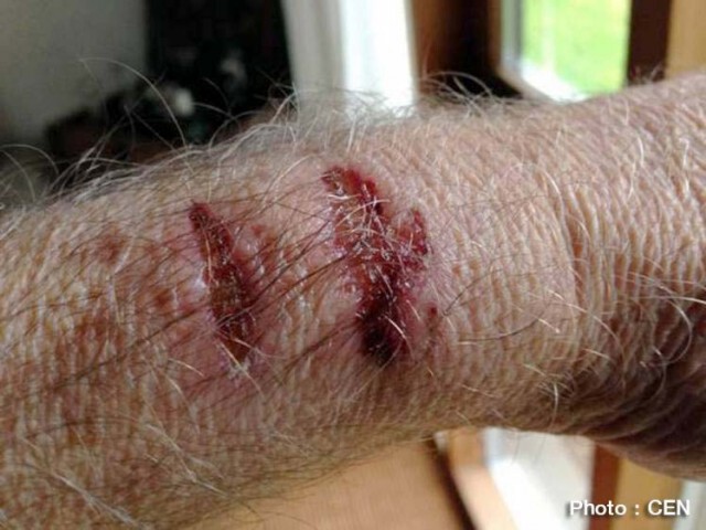 หนุ่มเดนมาร์กข้อมือเป็นแผลไหม้ เพราะ "Apple Watch" ร้อนจัด