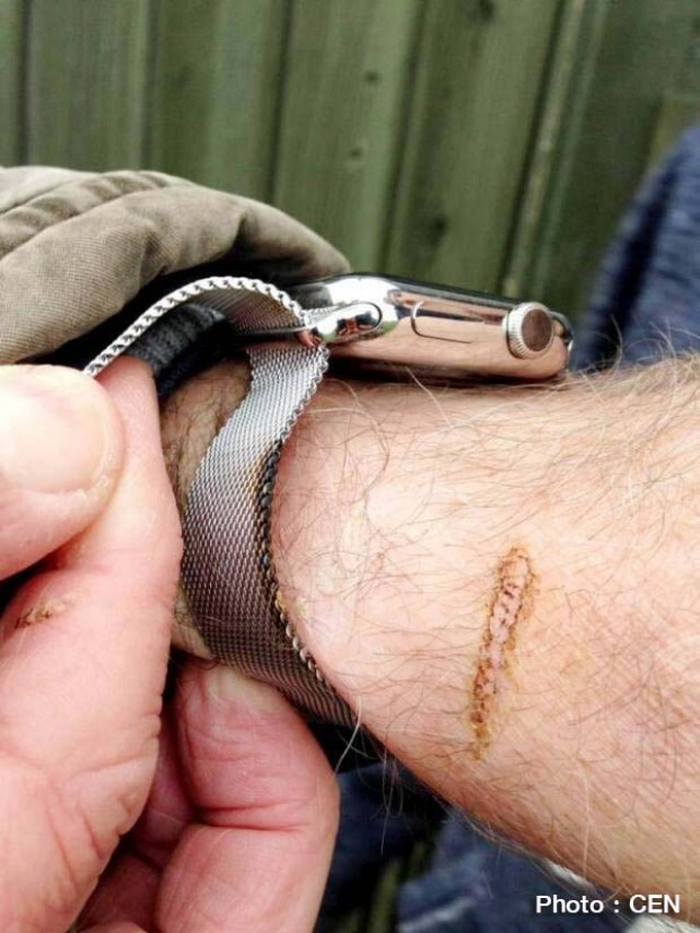 หนุ่มเดนมาร์กข้อมือเป็นแผลไหม้ เพราะ "Apple Watch" ร้อนจัด