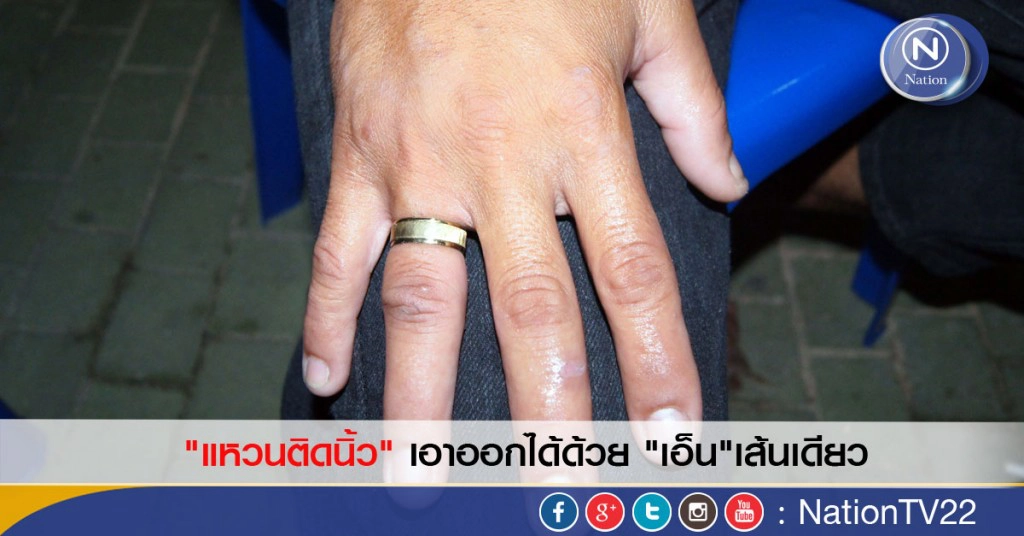 "แหวนติดนิ้ว" เอาออกได้ด้วย "เอ็น"เส้นเดียว