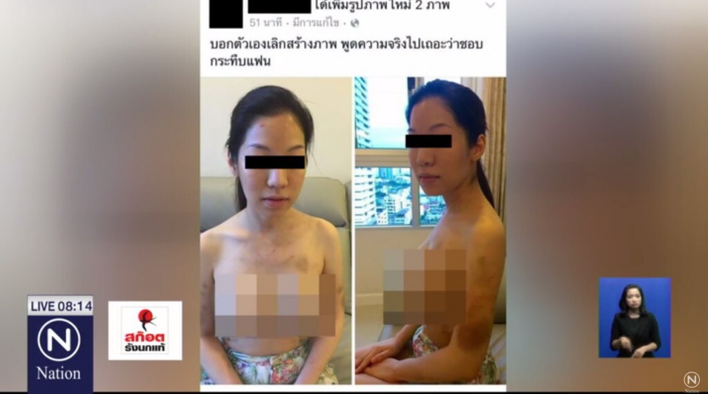 สาวโพสต์ภาพอ้างถูกลูกนักการเมืองซ้อม
