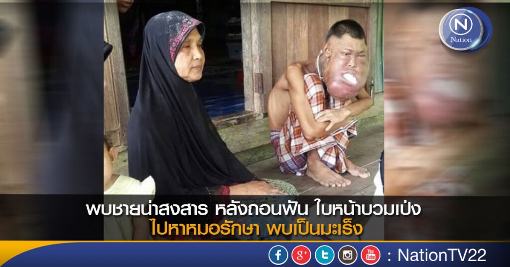 พบชายน่าสงสาร หลังถอนฟัน ใบหน้าบวมเป่ง ไปหาหมอรักษา พบเป็นมะเร็ง พบชายน่าสงสาร หลังถอนฟัน ใบหน้าบวมเป่ง ไปหาหมอรักษา พบเป็นมะเร็ง