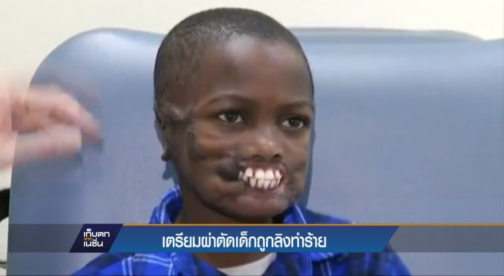 เตรียมผ่าตัดเด็กถูกลิงทำร้าย