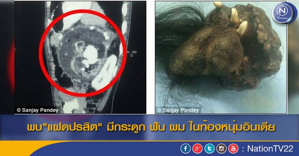 พบ"แฝดปรสิต" มีกระดูก ฟัน ผม ในท้องหนุ่มอินเดีย