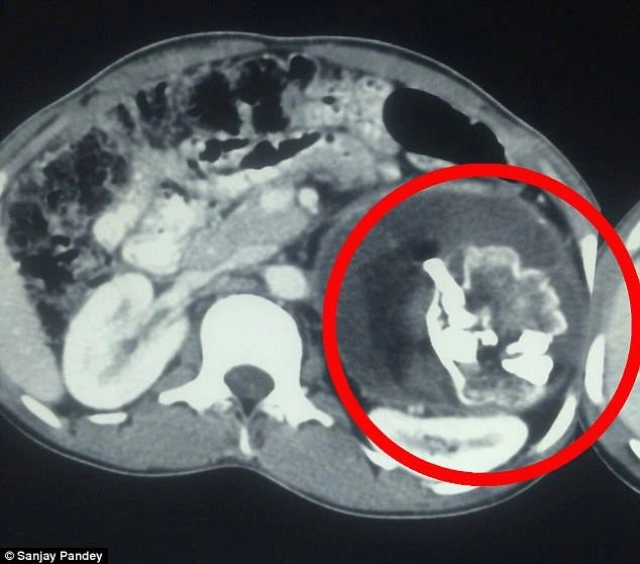 พบ"แฝดปรสิต" มีกระดูก ฟัน ผม ในท้องหนุ่มอินเดีย