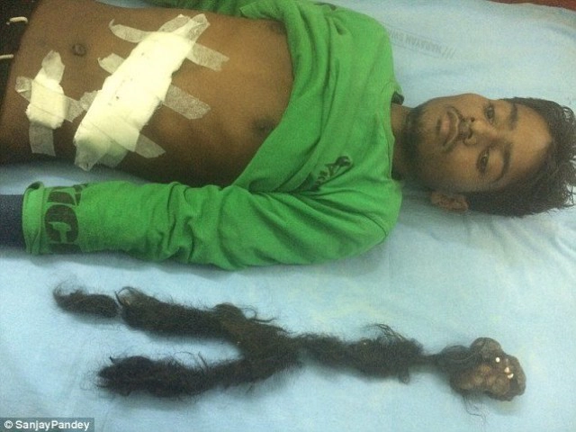 พบ"แฝดปรสิต" มีกระดูก ฟัน ผม ในท้องหนุ่มอินเดีย