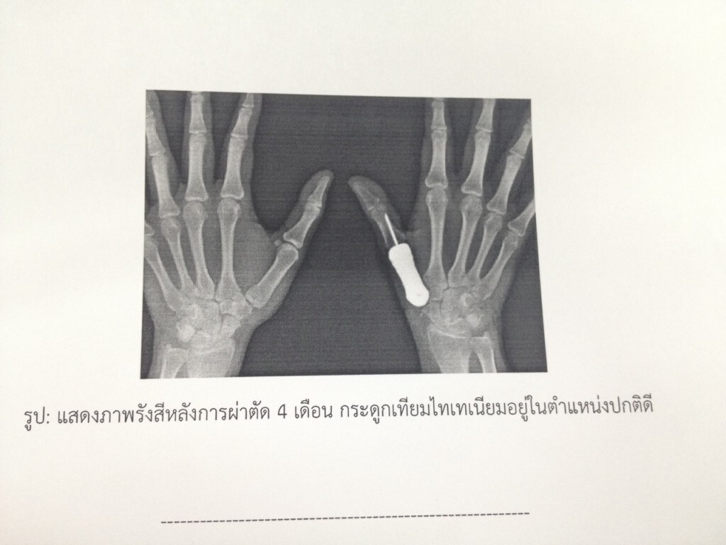 ครั้งแรกของโลกรพ.พระมงกุฎ-วิศวะจุฬาฯผ่าตัดเนื้องอกกระดูกนิ้วมือใช้กระดูกไทเทเนียมสำเร็จ