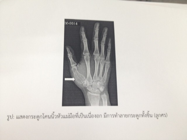 ครั้งแรกของโลกรพ.พระมงกุฎ-วิศวะจุฬาฯผ่าตัดเนื้องอกกระดูกนิ้วมือใช้กระดูกไทเทเนียมสำเร็จ