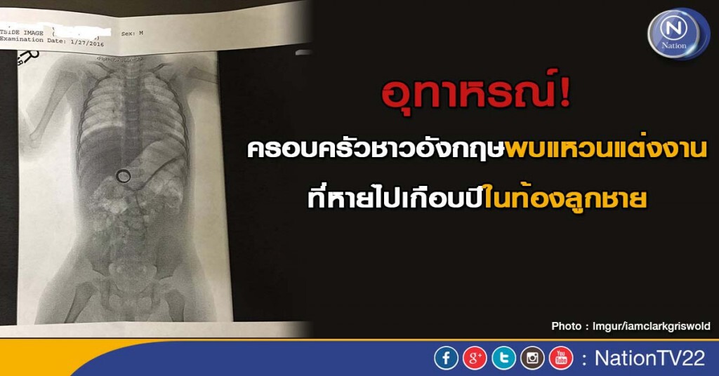 อุทาหรณ์!ครอบครัวชาวอังกฤษพบแหวนแต่งงานที่หายไปเกือบปีในท้องลูกชาย
