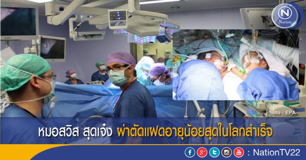 หมอสวิส สุดเจ๋ง ผ่าตัดแฝดอายุน้อยสุดในโลกสำเร็จ
