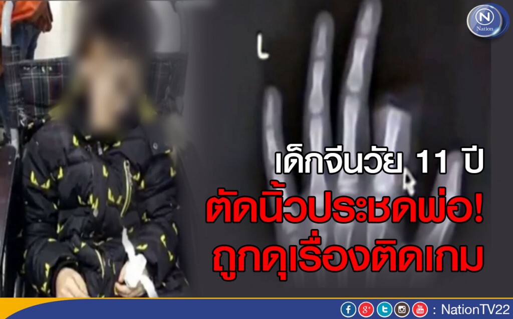 เด็กจีนวัย 11 ปี ตัดนิ้วประชดพ่อ ถูกดุเรื่องติดเกม