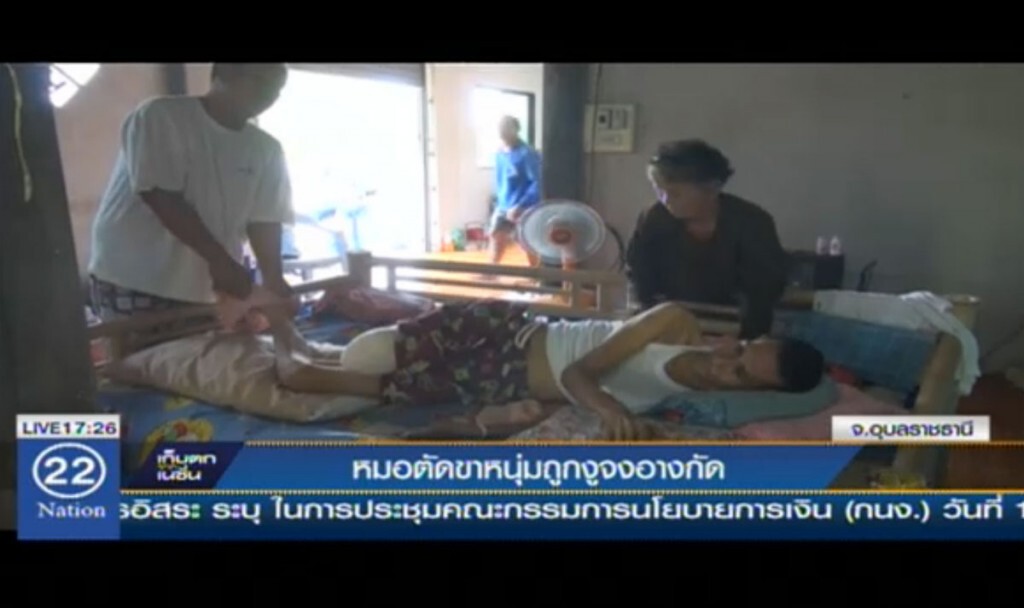 หมอตัดขาหนุ่มถูกงูจงอางกัด