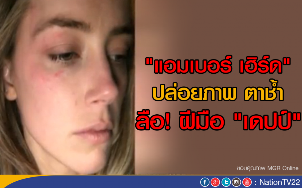 "แอมเบอร์ เฮิร์ด" ปล่อยภาพตาช้ำ ลือฝีมือ "เดปป์"