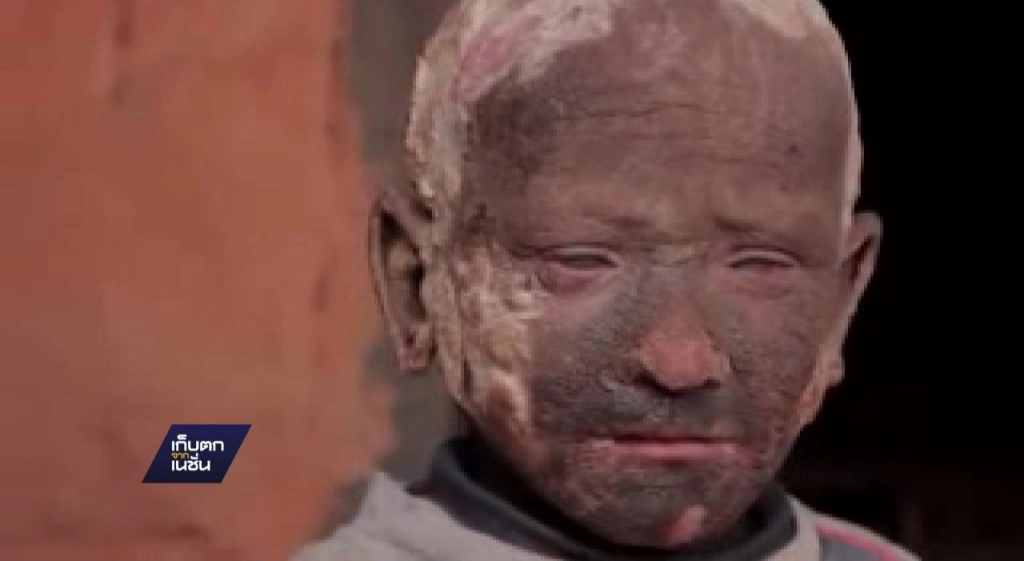 ช่วยเด็กชายผิวกลายเป็นหิน ช่วยเด็กชายผิวกลายเป็นหิน