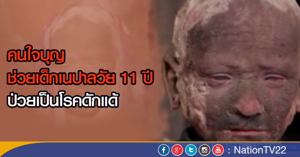 คนใจบุญช่วยเด็กเนปาล ป่วยเป็นโรคดักแด้ คนใจบุญช่วยเด็กเนปาล ป่วยเป็นโรคดักแด้