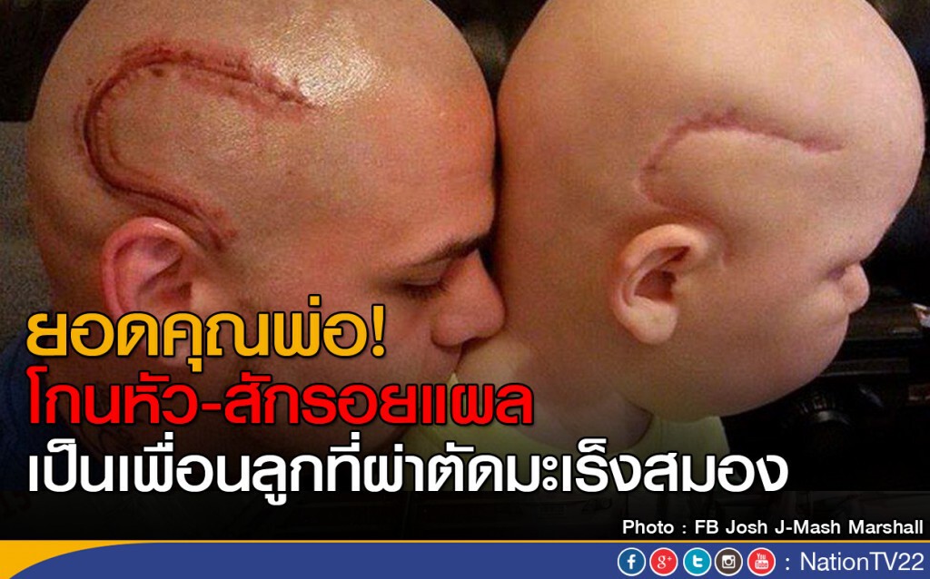 ยอดคุณพ่อ! โกนหัว-สักรอยแผลเป็นเพื่อนลูกที่ผ่าตัดมะเร็งสมอง ยอดคุณพ่อ! โกนหัว-สักรอยแผลเป็นเพื่อนลูกที่ผ่าตัดมะเร็งสมอง