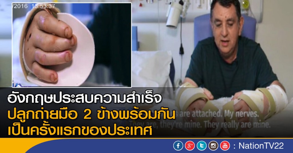อังกฤษปลูกถ่ายมือ 2 ข้างสำเร็จ อังกฤษปลูกถ่ายมือ 2 ข้างสำเร็จ