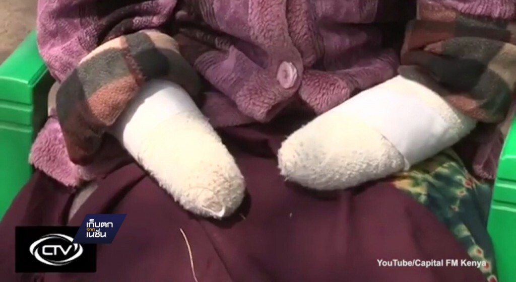 หญิงเคนยาถูกสามีตัดมือเพราะไม่มีลูก