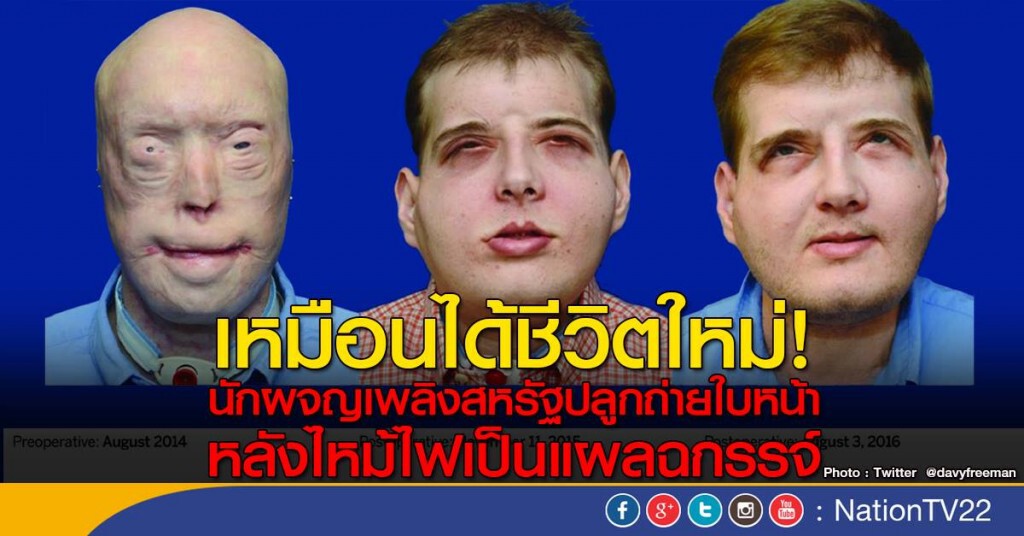 อดีตนักดับเพลิงสหรัฐ ผ่าตัดปลูกถ่ายใบหน้า อดีตนักดับเพลิงสหรัฐ ผ่าตัดปลูกถ่ายใบหน้า