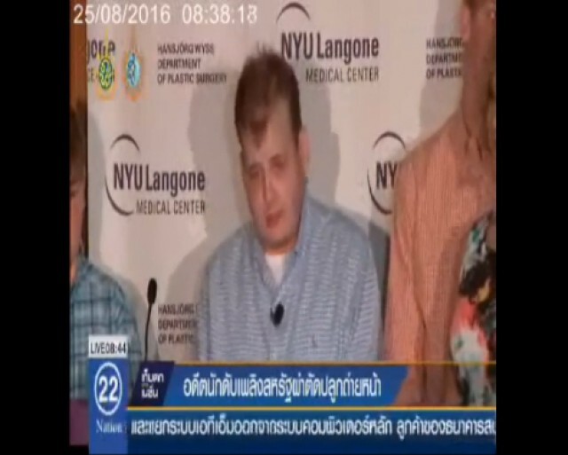 อดีตนักดับเพลิงสหรัฐ ผ่าตัดปลูกถ่ายใบหน้า