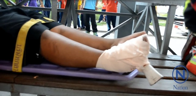 นร.ม.2 ใส่รองเท้าแตะ เดินบนอัฒจันทร์ดูกีฬา
เกิดลื่น! เหล็กเสียบคาเท้า