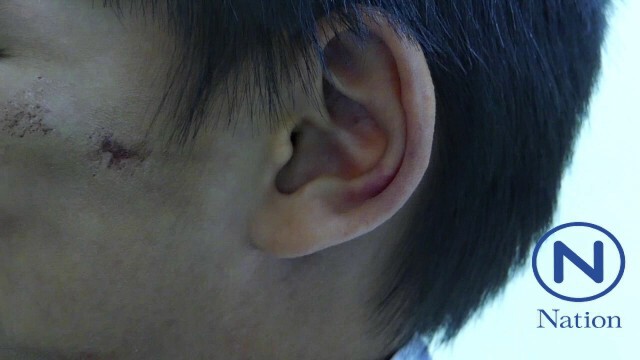 ครูสุดทน!
พาเด็ก 7 ขวบ ร้อง ศูนย์ฯรพ.ปทุมช่วย
ถูก"ทอม"แฟนใหม่แม่ 
ใช้ไม้เรียว-ไม้แขวน-เท้าถีบจนช้ำ