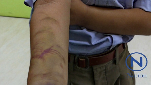 ครูสุดทน!
พาเด็ก 7 ขวบ ร้อง ศูนย์ฯรพ.ปทุมช่วย
ถูก"ทอม"แฟนใหม่แม่ 
ใช้ไม้เรียว-ไม้แขวน-เท้าถีบจนช้ำ