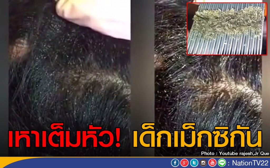 เหาเต็มหัว! เด็กเม็กซิกัน เหาเต็มหัว! เด็กเม็กซิกัน