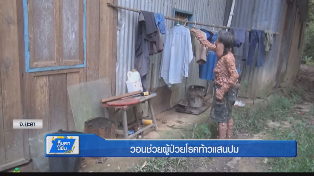 วอนช่วยผู้ป่วยโรคท้าวแสนปม