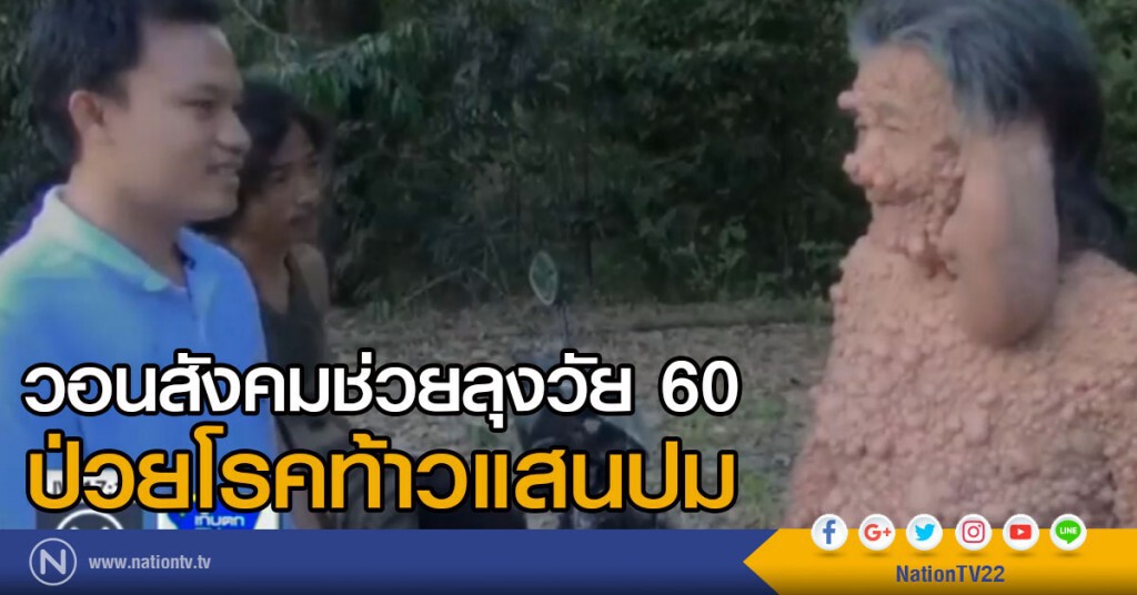 วอนสังคมช่วย ลุงวัย 60 ป่วยเป็นโรคท้าวแสนปม