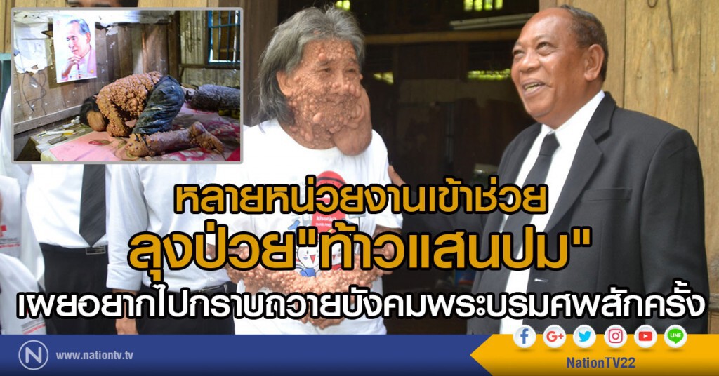 ยื่นมือช่วยชายป่วยโรคท้าวแสนปม ยื่นมือช่วยชายป่วยโรคท้าวแสนปม