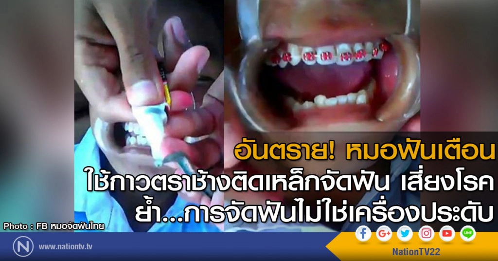 อันตราย! หมอฟันเตือน 
ใช้กาวตราช้างติดเหล็กจัดฟัน เสี่ยงโรค
ย้ำ...การจัดฟันไม่ใช่เครื่องประดับ