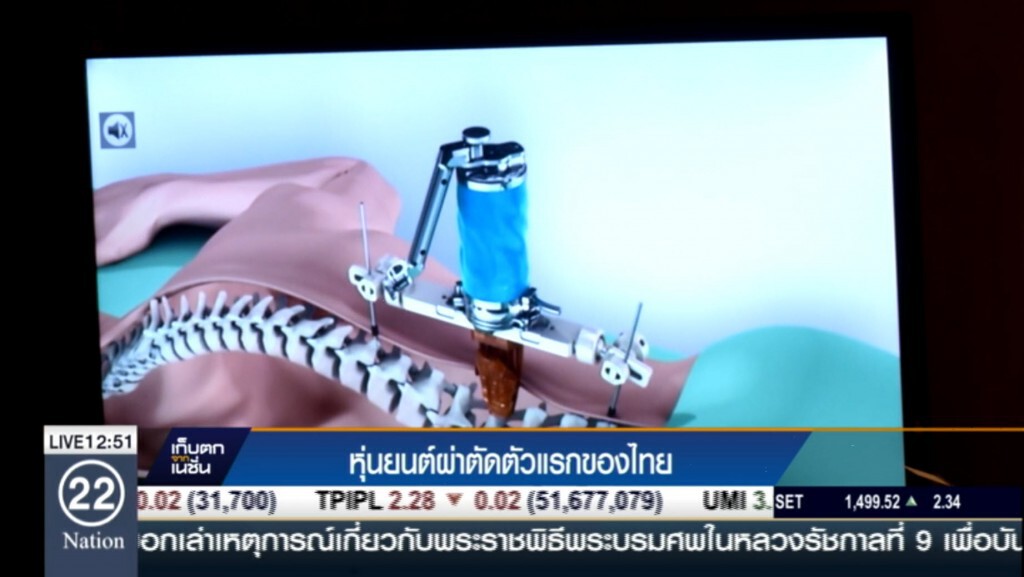 หุ่นยนต์ผ่าตัดตัวแรกของไทย