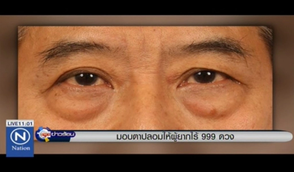 มอบตาปลอม ให้ผู้ยากไร้ 999 ดวงตา