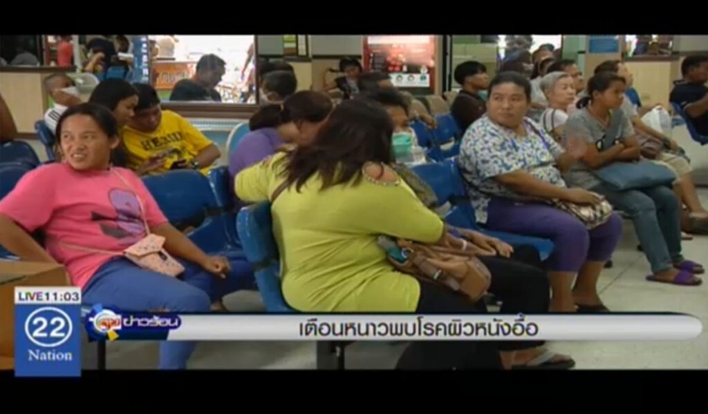 เตือนหนาว พบโรคผิวหนังอื้อ เตือนหนาว พบโรคผิวหนังอื้อ
