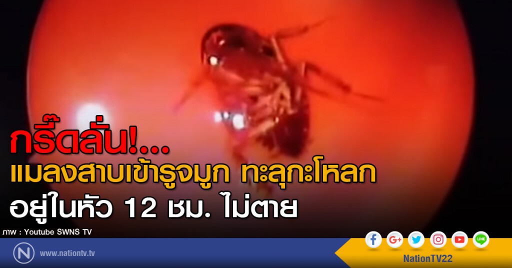 แพทย์ดึงแมลงสาบ ออกจากกะโหลกศีรษะ แพทย์ดึงแมลงสาบ ออกจากกะโหลกศีรษะ