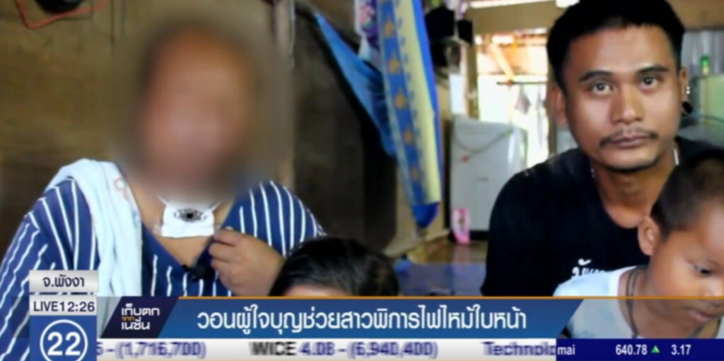 วอนผู้ใจบุญช่วย สาว 20 ถูกไฟไหม้ใบหน้าจนเสียโฉม วอนผู้ใจบุญช่วย สาว 20 ถูกไฟไหม้ใบหน้าจนเสียโฉม