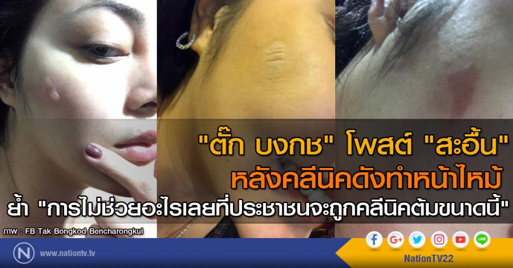 "ตั๊ก บงกช" โพสต์ "สะอื้น" หลังคลีนิคดังทำหน้าไหม้
