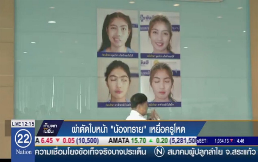 ผ่าตัดใบหน้า "น้องทราย" เหยื่อครูโหด ผ่าตัดใบหน้า "น้องทราย" เหยื่อครูโหด