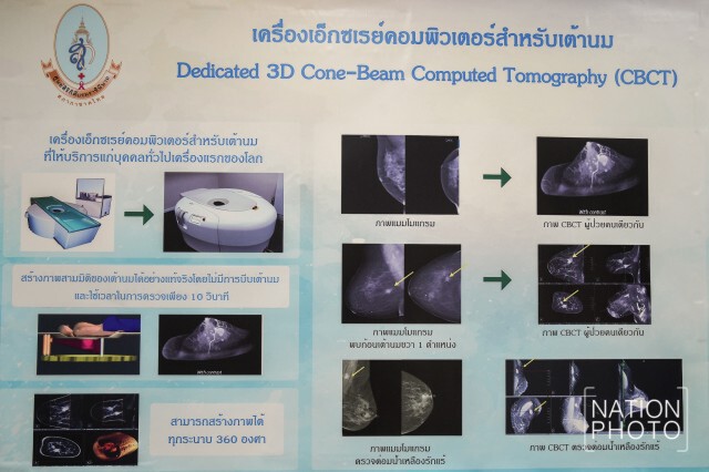 เครื่อง"เอ็กซเรย์เต้านม"ด้วยคอมพิวเตอร์ สำหรับบุคคลทั่วไป
