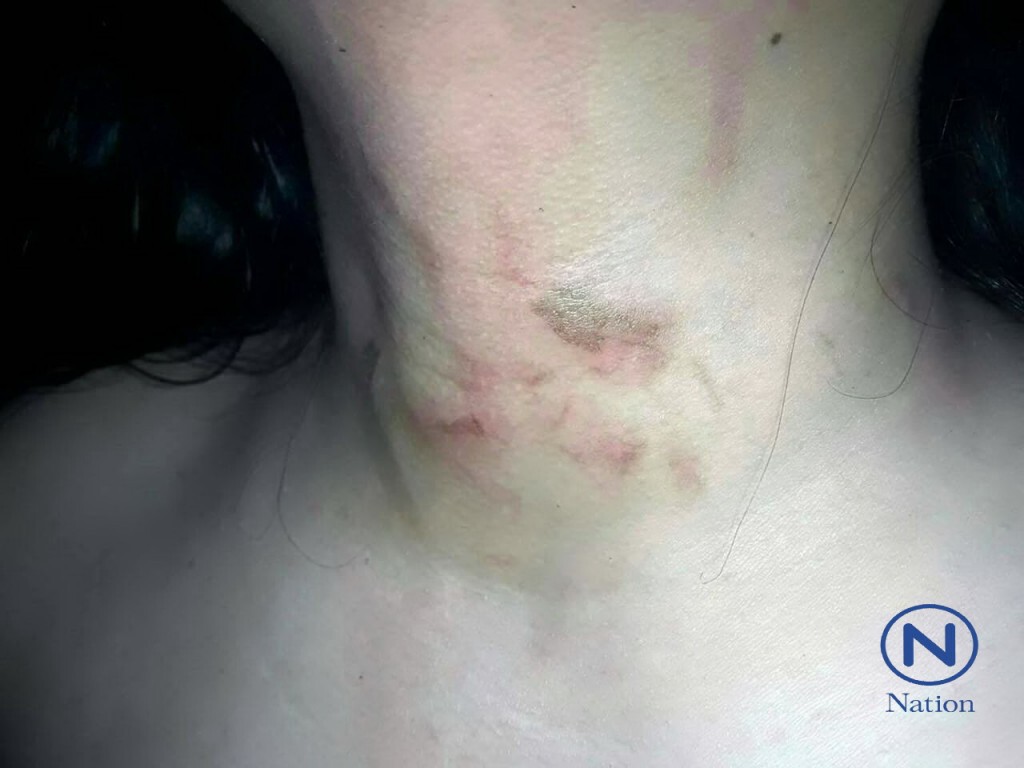 โจ๋อ้างปวดหัวบุกเข้าทำร้ายหมายข่มขืน เจ้าหน้าที่สาธารณสุข สติดีออกอุบายจนรอดมือโจ๋หื่น